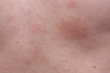 Example dermatological skin allergy